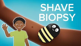 Shave Biopsy  Cincinnati Childrens [upl. by Aizan]