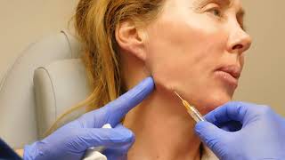 Jawline Correction with Filler with Dr Janowski [upl. by Otxilac]