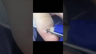 Ingrown toenail removal with Pedicure Knife Cut it easily Ep260 [upl. by Anomas]