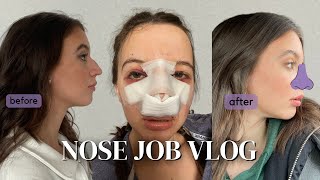 I GOT A NOSE JOB  My honest rhinoplasty experience and recovery  NOSE REVEAL [upl. by Lipp]