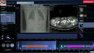 livectscan CT Pulmonary Angiography Important Trick  pulmonaryangio  Radiologydept [upl. by Eisse391]