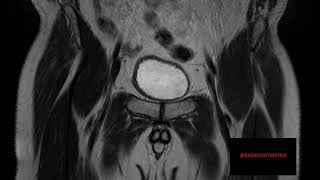 MRI AVASCULAR NECROSIS OF FEMUR  4K [upl. by Ettevram]