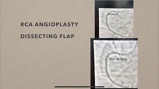 Dissecting Flap and RCA ANGIOPLASTY [upl. by Nylanna]