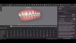 Carriere Motion Appliance  Invisalign [upl. by Eintruok864]