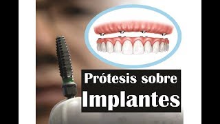 PROTESIS DENTALES SOBRE IMPLANTES  PRODENT [upl. by Ginger977]