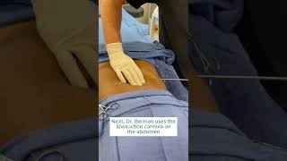 SmartLipo Procedure on Patients Abdomen [upl. by Hasin]