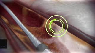 Coronary Orbital Atherectomy Long video [upl. by Bilicki65]