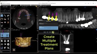 CS 3D Imaging Multipe Treatment Plans [upl. by Cadal276]