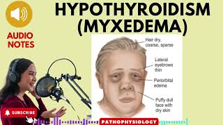 Hypothyroidism Myxedema Causes SignsSymptoms amp treatment [upl. by Adriene]