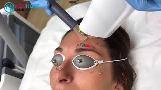 Laser Tattoo Removal  Face tattoo above eyebrow  Newhope Laser Skin Care  Orange County [upl. by Munniks]