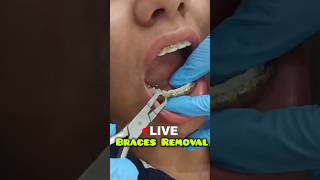 LIVE Braces Removal Dr Srishti Bhatia braces teeth smile [upl. by Winnick]