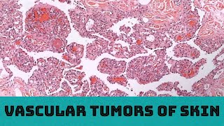 Vascular Tumors of Skin 31 cases in 3 hours Board Review for Pathology Dermatology Dermpath [upl. by Cryan217]