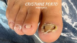 😨 OLHA COMO O PEELING REAGIU NESTE PÉ nails satisfatório viralvideo [upl. by Hamel525]