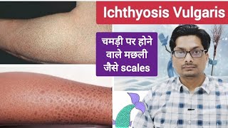 चमड़ी पर होने वाले मछली जैसे scales  Ichthyosis Vulgaris  Itchy dry fish like skin ichthyosis [upl. by Marcello427]