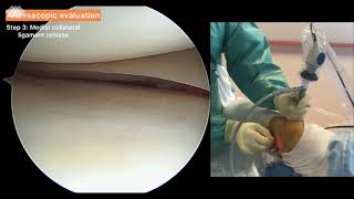 Meniscal Ramp Lesions Repair An UnderMeniscus AllInside Suture in Cases [upl. by Aeniah988]