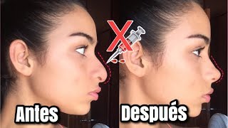 RINOPLASTIA CASERA EN MINUTOS  RESPINGADORES PARA NARIZ BONITA [upl. by Gnuhn514]