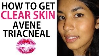 Use Drugstore AntiAcne Cream to Clear Up Acne Avene TriAcneal Review [upl. by Adne]