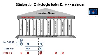 Säulen der Onkologie beim Zervixkarzinom  Strahlentherapie Prof Hilke Vorwerk [upl. by Nahgrom]