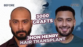 Captivating Transformation 3000 Grafts Hair Transplant Before and After Stunning 12Month Results [upl. by Namron397]