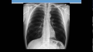 Dispnee cu radiografie toracica normala [upl. by Blaire171]