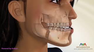 Surgical Orthodontic Treatment for Underbite or Crossbite  Transcortical Mandibular Setback [upl. by Dorthy]