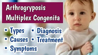 Arthrogryposis Multiplex Congenita AMC  Multiple Newborn Joint Contractures at Birth [upl. by Hogen]