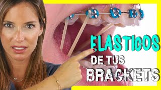 🖍📒ELASTICOS INTERMAXILARES para asentar MORDIDA  Para que sirven las GOMAS de los BRACKETS [upl. by Ojyram]