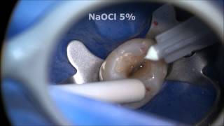 Endodontic Access and Root Canal Preparation explained [upl. by Begga]