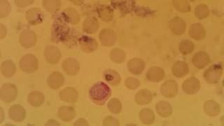 Plasmodium vivax gametocyte stage [upl. by Anerbas]