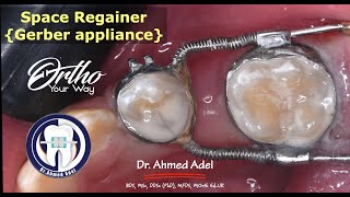 Space regainer using Gerber appliance steps  ortho pedo relation [upl. by Kennett]