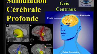 Stimulation Cerebrale Profonde maladie de parkinson tremblements [upl. by Sephira]