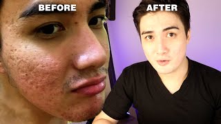 HOW I GOT RID OF MY ACNE SCARS Philippines 2021  Envi Beauty [upl. by Chemush]