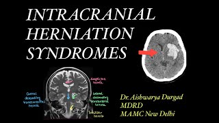 Intracranial herniation syndromes Imaging review  Relevant Anatomy [upl. by Erodaeht]