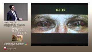 Ocular Cicatricial Pemphigoid Multidisciplinary Approach [upl. by Irat]