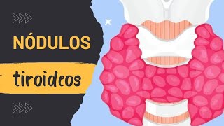 NÓDULOS TIROIDEOS CAUSAS SÍNTOMAS TRATAMIENTO BOLITAS EN EL CUELLO [upl. by Anaderol773]