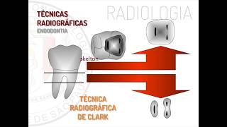 Radiologia em Endodontia  Técnica de Clark [upl. by Natascha]