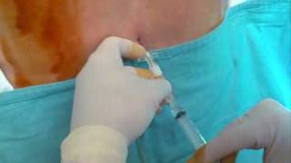 CSE combined spinal epidural anaesthesia needle to needle tecnique [upl. by Sebbie931]