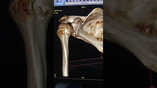 Post op CT scan bone block surgery  double button bone block technique [upl. by Enitsyrk]