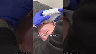 Ulthera or Ultherapy HIFU Skin Tightening Treatment  Sydney Australia [upl. by Ayaet56]