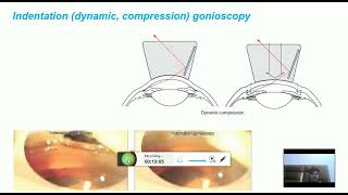 Direct and indirect gonioscopy grading systems ie shaffer scheie and spaeth [upl. by Yzmar]