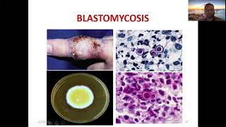 Systemic mycosis [upl. by Irec]