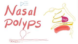 Nasal Polyps Allergic Rhinitis and Cystic Fibrosis [upl. by Judon]