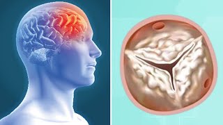 Heart Valve Calcification amp Stroke Risk What Should Patients Know [upl. by Porter]