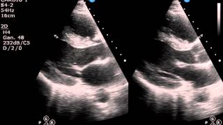 ECOCARDIOGRAMA NORMAL [upl. by Saibot]