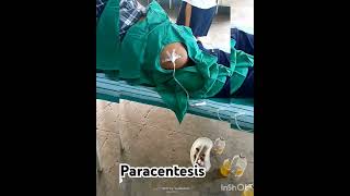 abdominal paracentesis tapping for ascitic fluid aryanglaascitis😷🩺💖⛑️ Sudarshanlipane177 [upl. by Otxis]