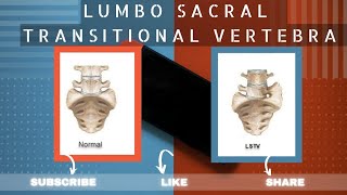 LUMBOSACRAL TRANSITIONAL VERTEBRAE  LSTV  LUMBARIZATION  SACRALIZATION  BERTOLOTTI SYNDROME [upl. by Hunt]