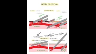 Venipuncture  How to Position a Needle [upl. by Babcock]