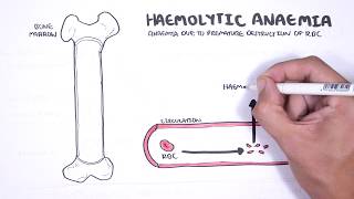 Haemolytic Anaemia  classification intravascular extravascular pathophysiology investigations [upl. by Sheeran]