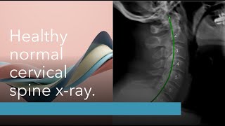 Platinum Chiropractic Erina Xray Explanation [upl. by Leanne]