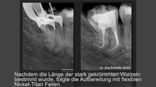 Aufbereitung und Desinfektion des Wurzelkanals [upl. by Ylsel]